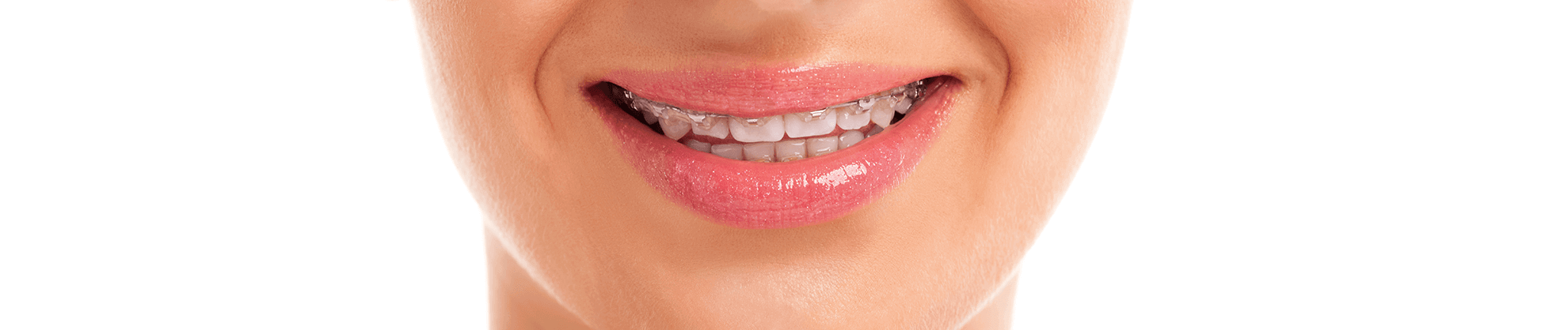 Overbite / Underbite Treatment in Sacramento and Elk Grove,CA