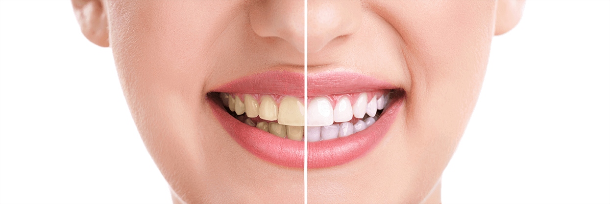 Teeth Whitening in Sacramento and Elk Grove, CA